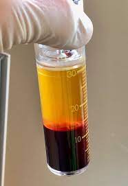 a photo of a medical professional holding a Pure PRP tube after the first spin has density separated the different components of the blood which now clearly show a plasma layer, a buffy coat and and Red Blood Cell layer.