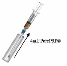 Final EmCyte PRP Processing step showing the removal of the resultant PRP from the second concentrating tube