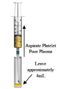 EmCyte PRP processing step showing the PPS being aspirated out of the second concentration device leaving a small amount for the platelets to be resuspended into